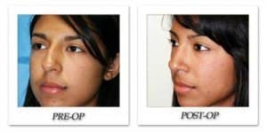 phoca_thumb_m_dr-begovic-rhinoplasty-before-after-001-oblique2