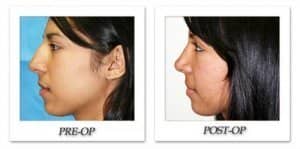 phoca_thumb_m_dr-begovic-rhinoplasty-before-after-001-side