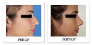 phoca_thumb_m_dr-begovic-rhinoplasty-before-after-002-side
