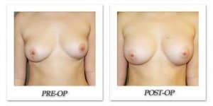 phoca_thumb_l_before-after-021