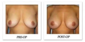 phoca_thumb_l_bruno-breast-augmentation-001