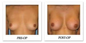 phoca_thumb_l_bruno-breast-augmentation-004