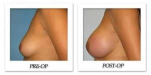 phoca_thumb_l_bruno-breast-augmentation-006