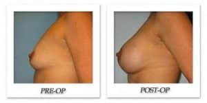 phoca_thumb_l_bruno-breast-augmentation-009
