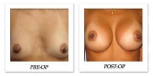 phoca_thumb_l_bruno-breast-augmentation-010