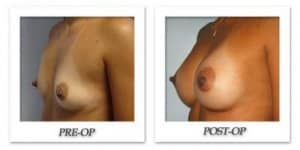 phoca_thumb_l_bruno-breast-augmentation-011