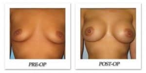 phoca_thumb_l_bruno-breast-augmentation-013