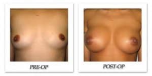 phoca_thumb_l_bruno-breast-augmentation-016