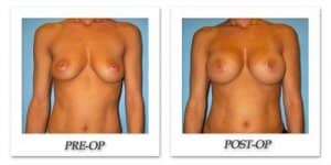 phoca_thumb_l_bruno-breast-augmentation-020
