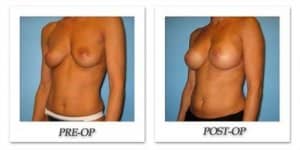 phoca_thumb_l_bruno-breast-augmentation-021
