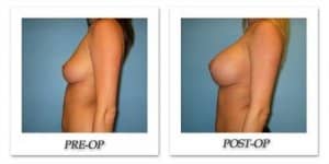 phoca_thumb_l_bruno-breast-augmentation-025