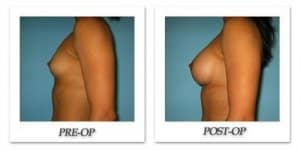 phoca_thumb_l_bruno-breast-augmentation-030