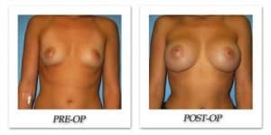 phoca_thumb_l_bruno-breast-augmentation-031