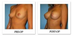 phoca_thumb_l_bruno-breast-augmentation-032