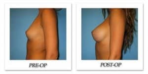 phoca_thumb_l_bruno-breast-augmentation-033