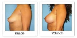 phoca_thumb_l_bruno-breast-augmentation-044