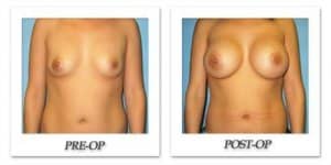 phoca_thumb_l_bruno-breast-augmentation-045