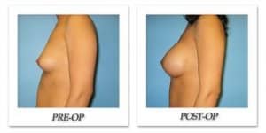 phoca_thumb_l_bruno-breast-augmentation-046