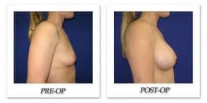 phoca_thumb_l_cohen-breast-augmentation-004