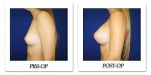 phoca_thumb_l_cohen-breast-augmentation-012