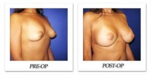 phoca_thumb_l_cohen-breast-augmentation-020
