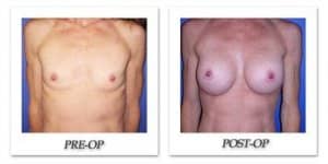 phoca_thumb_l_cohen-breast-augmentation-028