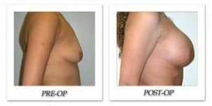 phoca_thumb_l_hodnett-breast-augmentation-007