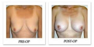 phoca_thumb_l_hodnett-breast-augmentation-008