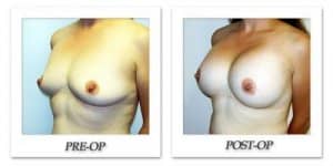 phoca_thumb_l_hodnett-breast-augmentation-012