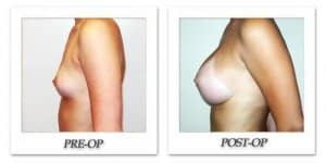 phoca_thumb_l_hodnett-breast-augmentation-014