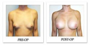 phoca_thumb_l_hodnett-breast-augmentation-016