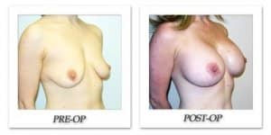 phoca_thumb_l_hodnett-breast-augmentation-024