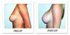 phoca_thumb_l_hodnett-breast-augmentation-026