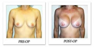 phoca_thumb_l_hodnett-breast-augmentation-027