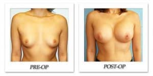 phoca_thumb_l_hodnett-breast-augmentation-034