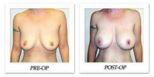 phoca_thumb_l_hodnett-breast-augmentation-037