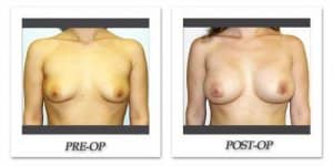phoca_thumb_l_hodnett-breast-augmentation-040