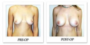 phoca_thumb_l_hodnett-breast-augmentation-042
