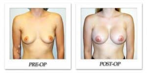 phoca_thumb_l_hodnett-breast-augmentation-044