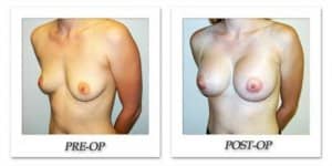phoca_thumb_l_hodnett-breast-augmentation-046