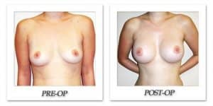 phoca_thumb_l_hodnett-breast-augmentation-047