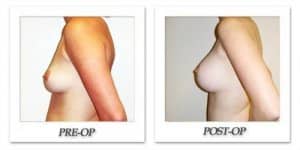 phoca_thumb_l_hodnett-breast-augmentation-048