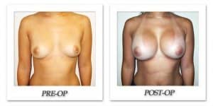 phoca_thumb_l_hodnett-breast-augmentation-050