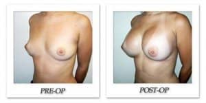 phoca_thumb_l_hodnett-breast-augmentation-052