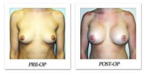 phoca_thumb_l_hodnett-breast-augmentation-053