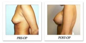 phoca_thumb_l_hodnett-breast-augmentation-057