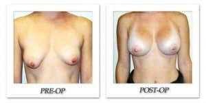phoca_thumb_l_hodnett-breast-augmentation-058