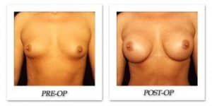phoca_thumb_l_hodnett-breast-augmentation-patient10-front