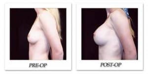 phoca_thumb_l_hodnett-breast-augmentation-patient11-side