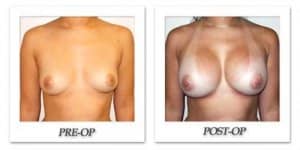phoca_thumb_l_hodnett-breast-augmentation-patient14-front